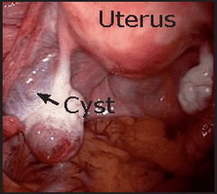 ruptured ovarian cyst bleeding